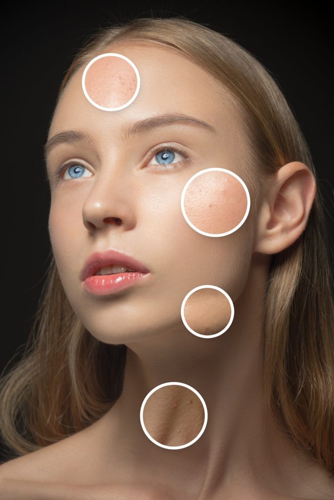 Different Concepts And Options Of Acne Treatment Cosmetics And You